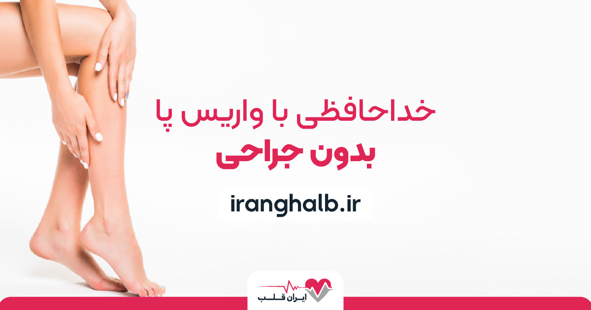 خداحافظی با واریس پا بدون جراحی