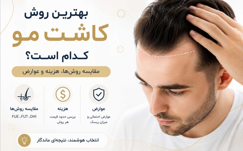 بهترین روش کاشت مو کدام است؟ (مقایسه روش‌ها، هزینه و عوارض)